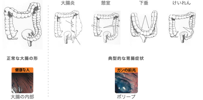 正常な大腸の形と典型的な胃腸症状